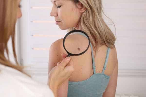 What Are Traditional Skin Lesion Removal Methods Billericay?