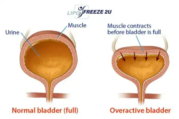 diagram of overactive bladder treatment Billericay