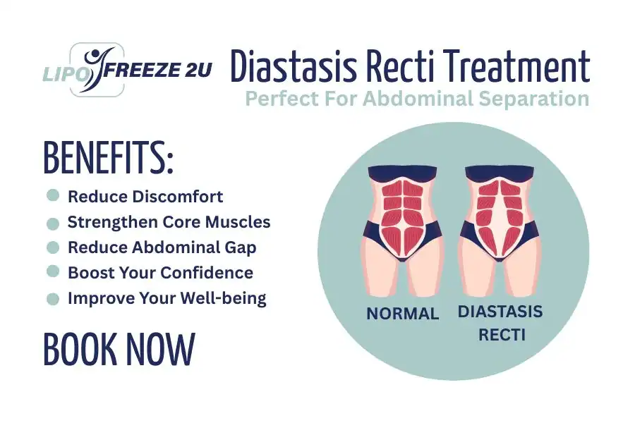 How Long Will It Take to See Improvements in Diastasis Recti Billericay