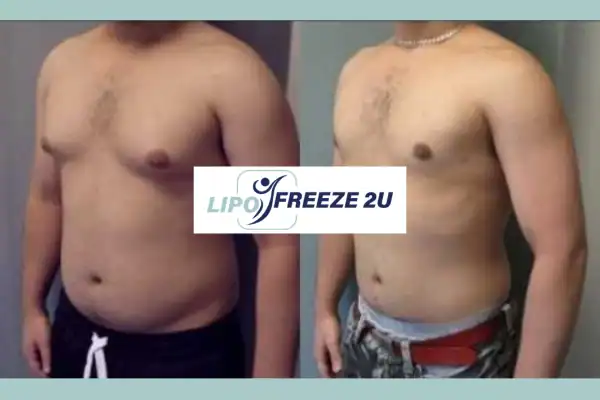 How Long Does It Take to See Results Billericay?
