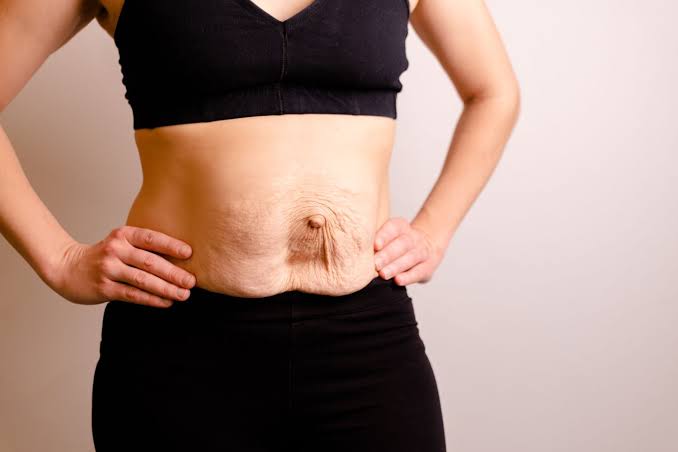 Is Surgery Really the Only Way to Repair Diastasis Recti Billericay?