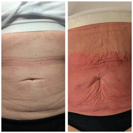 How Does RF Microneedling Improve Crepey, Thin and Uneven Skin Texture Billericay?