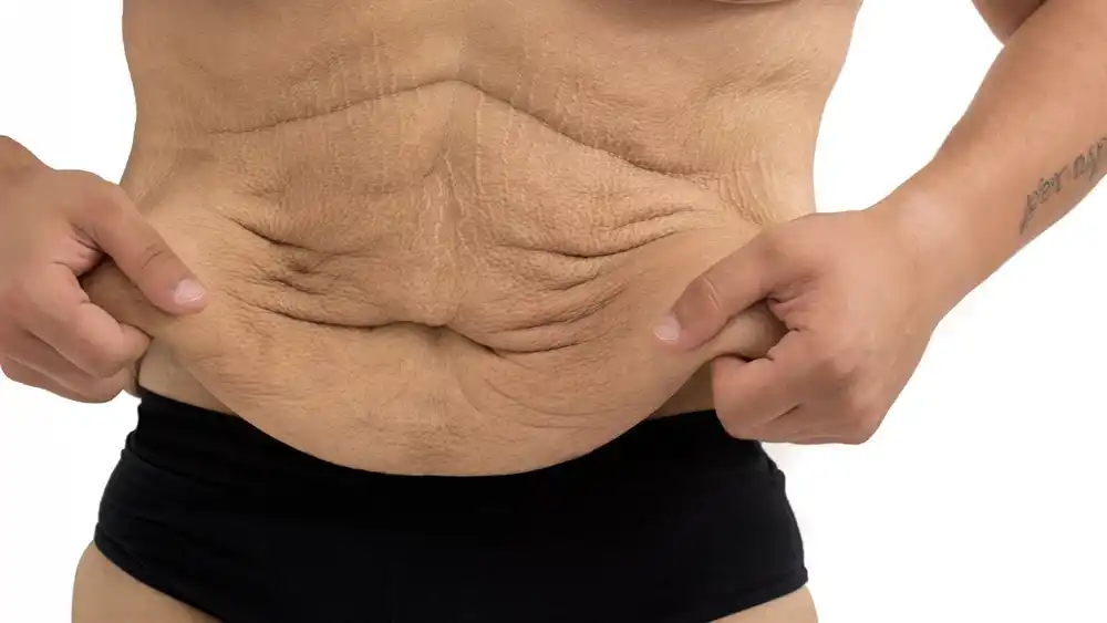 Why Does Weight Loss Medication Leave Some People With Loose or Sagging Skin Billericay?